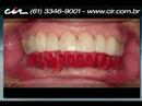 Protocolo inferior é o nome dado a técnica que substitui todos dentes na arcada inferior através de implantes dentários. O implante dental é um pequeno cilindro confeccionado em titânio puro, com roscas externas semelhante a um parafuso. O titânio adere ao tecido ósseo, produzindo uma ligação biológica entre o osso eo titânio, conhecida como osseointegração.