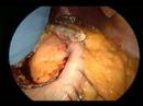 IntraOperative Video: Mini-Gastric Bypass