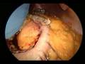 IntraOperative Video: Mini-Gastric Bypass