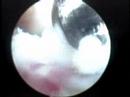 Operacion Artroscopica Rodilla