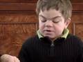 Hunter Syndrome