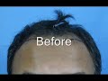 Justine hair transplant result (2500 fuht grafts)