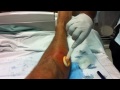 R Leg Abscess I&D