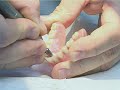 TIMPs Miniimplantes Transgingivales Dr. Wolfgang Forstner TIMPs Miniimplantes Transgingivales Dr. Wolfgang Forstner