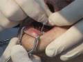 videos de TIMPs Miniimplantes Transgingivales Dr. Wolfgang Forstner