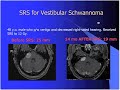Click here to watch this video Definition of Sterotactic Radiosurgery