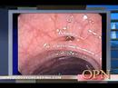 Two New Drugs for Renal Cell Cancer Renal Cell Cancer