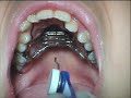 dr. chris maulik, of scripps poway orthodontics, demonstrates how to turn the rapid palatal expander (rpe).  the expander should not be turned more than 1 to 2 times per day.  always make sure your orthodontist closely watches the progression of the turns.  never continue to turn without periodic supervision.