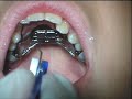 dr. chris maulik, of scripps poway orthodontics, demonstrates how to turn the rapid palatal expander (rpe).  the expander should not be turned more than 1 to 2 times per day.  always make sure your orthodontist closely watches the progression of the turns.  never continue to turn without periodic supervision.