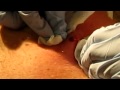 Nasty AF_ Guy Cyst Gets Drained At His Family Reunion On The Kitchen Counter!