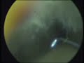 F.B.Thermocol in the Ear.wmv