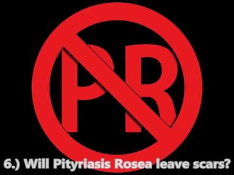 how to treat pityriasis rosea