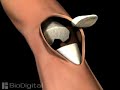 knee replacement knee replacement
