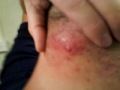 Cyst on my neck gross ( lots of puss)