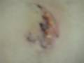 Cellulitis in Leg - Celulitis En Pierna