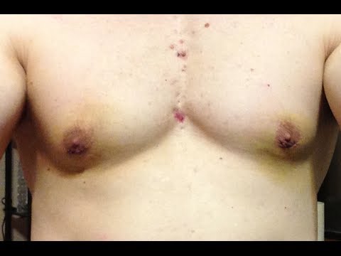 how to get rid gynecomastia naturally