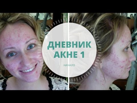 Дневник акне 1. Начало лечения и уход за кожей / Acne Update + Acne Skincare