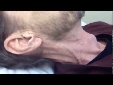 how to assess jugular vein distention