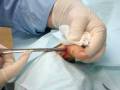 videos de Pin Removal