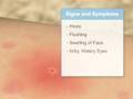Anaphylactic allergic reaction