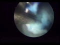 Fantomas - Der Golem - HNP L4-L5, Hernia de Núcleo Pulposo Lumbar