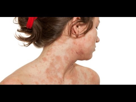 how to get rid prickly heat