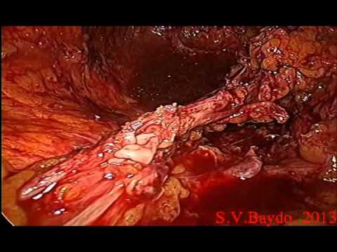 how to repair ureteral injuries