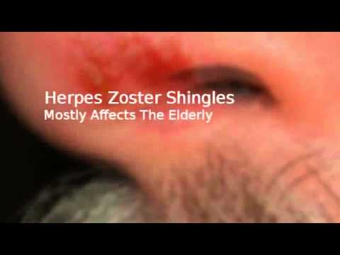 how to assess herpes zoster