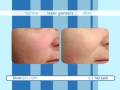 videos de IPL FotoFacial