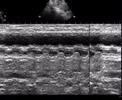 An egg  inside  Left atrium !