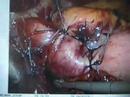 Don't Let Heartburn Or Acid Reflux Get This Bad 