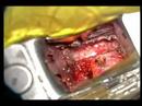 spinal disc prolapse and replacement OP-END spinal disc prolapse and replacement OP-END