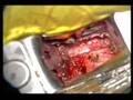 spinal disc prolapse and replacement OP-END