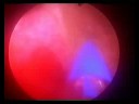 green light laser vaporisation of the enlarged prostate