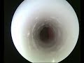 Abnormal airway dynamics caused by relapsing polychondritis