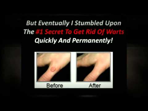how to avoid warts