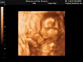 Baby Girl 3d Ultrasound 19 weeks