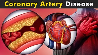 How Coronary Artery Disease Work?  Symptoms Causes