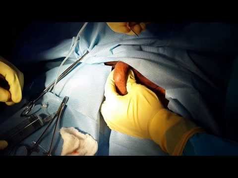how to recover sperm