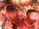 posterior fossa
