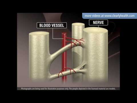 video-linktoworks-Diabetes: Nerve damage (Neuropathy)