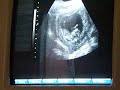 12 week sonogram