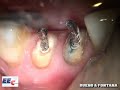 Remoção de Pino Rosqueável – Equipe de Endodontia de Campinas