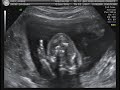 Baby Midkiff 3 of 5