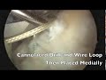 Dr Christopher Vertullo, Specialist Orthopaedic Knee Surgeon, arthroscopically reduces and fixes an Anterior Cruciate Ligament Avulsion Fracture in a skeletally immature male. The fixation is undertaken with a heavy absorbable suture, with supplemental fixation with three smart nails