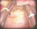 P�lipo Endometrial