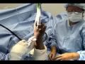 mreesescopescaphoid.mov