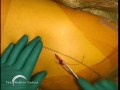 Birmingham Hip Resurfacing (BHR) by Derek McMinn Part 1
