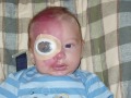 My son Aiden was born with a port wine stain birthmark and diagnosed with Sturge-Weber syndrome. I hope his story educates and raises awareness for this rare disease.The song in the video is 
