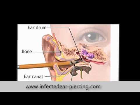 how to treat an infected ear piercing